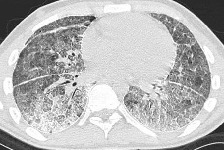 HRCT thorax from a patient with pulmonary alveolar microlithiasis (PAM). HRCT thorax from a patient with pulmonary alveolar microlithiasis (PAM).